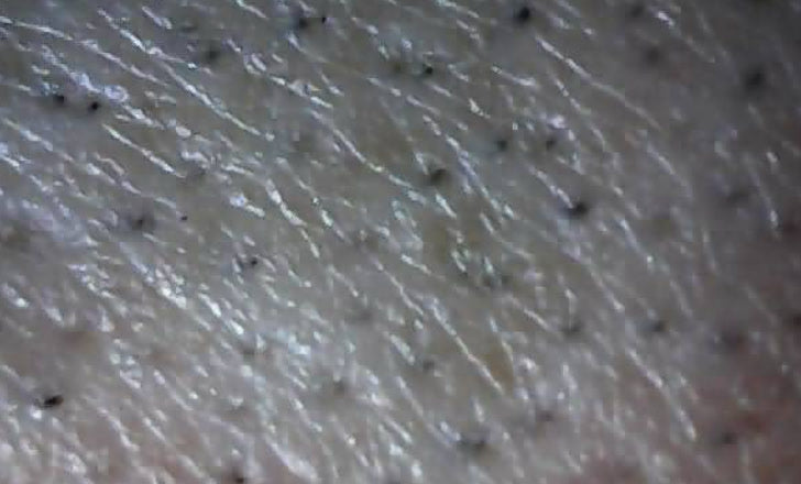 Cut at the skin line